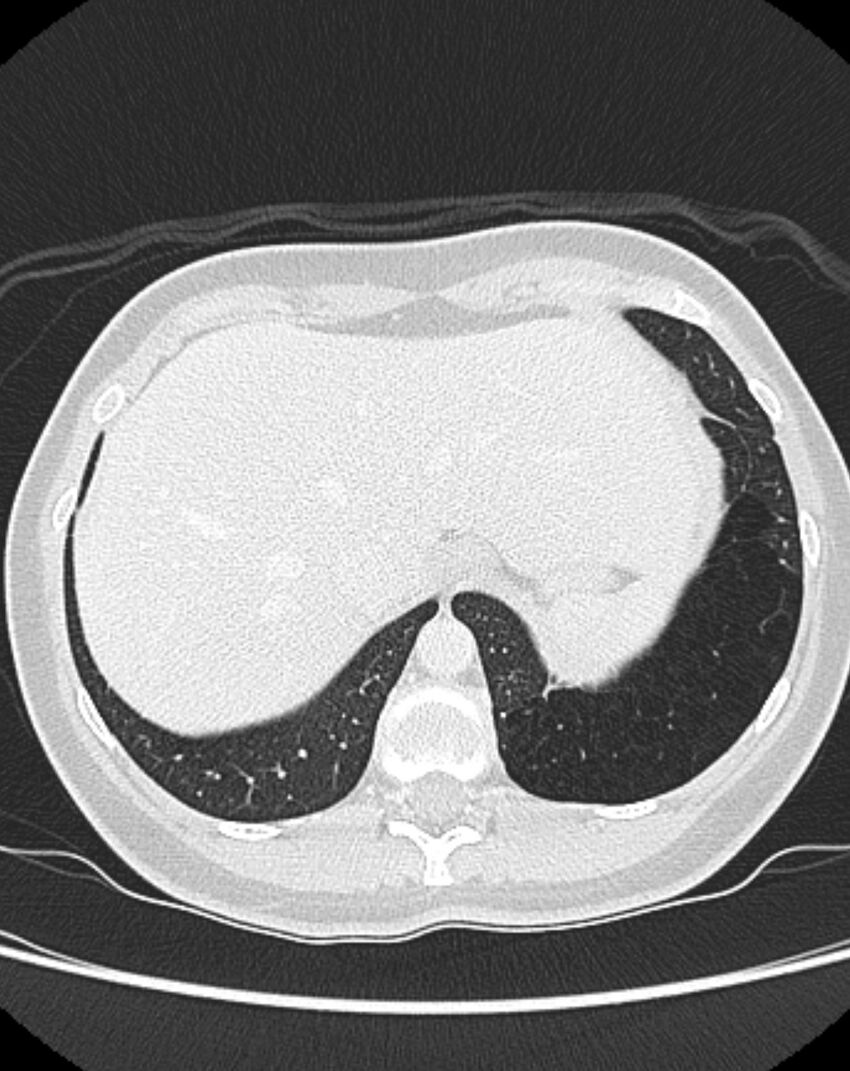 Bronchial atresia (Radiopaedia 50007-55297 Axial lung window 98).jpg