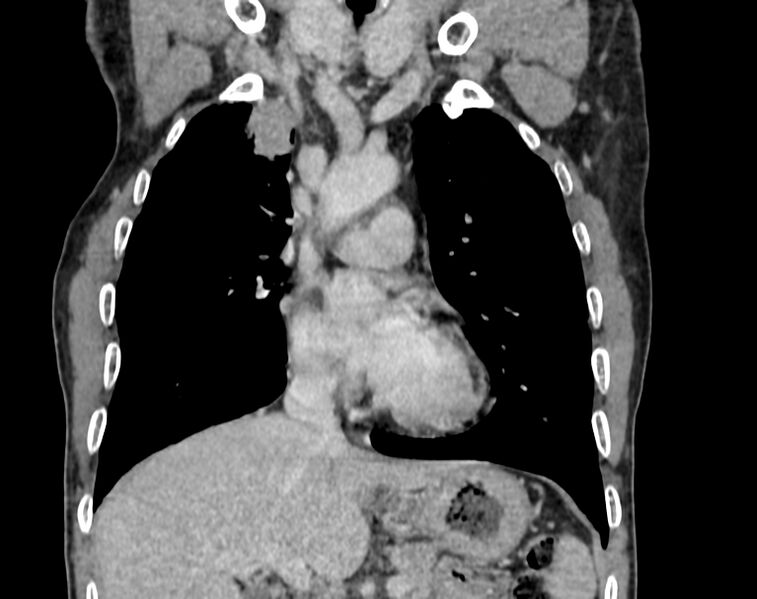 File:Bronchogenic carcinoma with superior vena cava syndrome (Radiopaedia 36497-38054 Coronal C+ delayed 22).jpg
