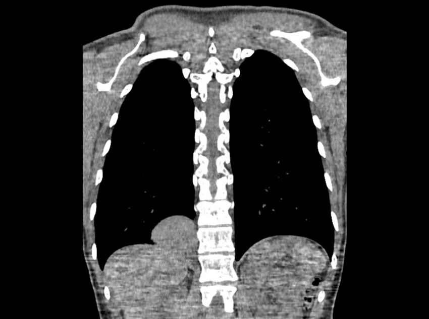 Bronchogenic cyst (Radiopaedia 80273-93615 D 100).jpg