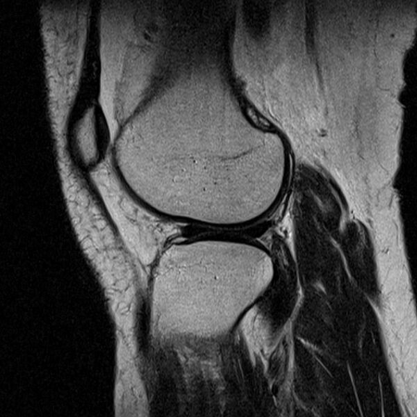File:Bucket handle tear - medial meniscus (Radiopaedia 79028-91942 Sagittal T2 6).jpg