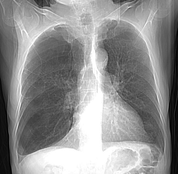 File:Bullous emphysema (Radiopaedia 15948-15598 Frontal 1).jpg