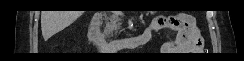 File:Buried bumper syndrome - gastrostomy tube (Radiopaedia 63843-72575 Coronal Inject 46).jpg