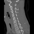 C5 facet fracture (Radiopaedia 58374-65499 Sagittal bone window 33).jpg