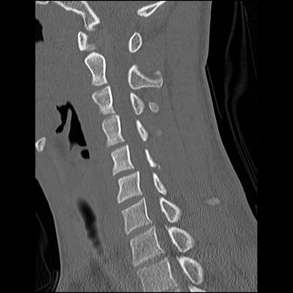 File:C5 facet fracture (Radiopaedia 58374-65499 Sagittal bone window 33).jpg