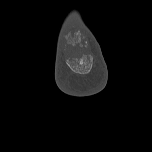 File:Calcaneal tuberosity avulsion fracture (Radiopaedia 22649-22668 Coronal bone window 68).jpg
