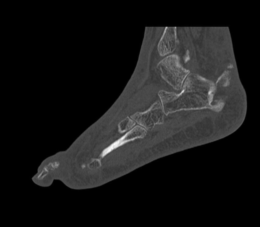Calcaneal tuberosity avulsion fracture (Radiopaedia 22649-22668 Sagittal bone window 13).jpg