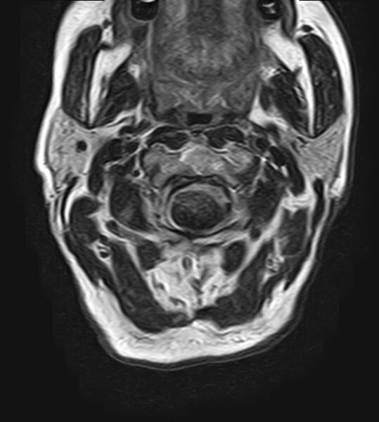 File:Calcified meningioma - cervical canal (Radiopaedia 70136-82468 Axial T2 7).jpg