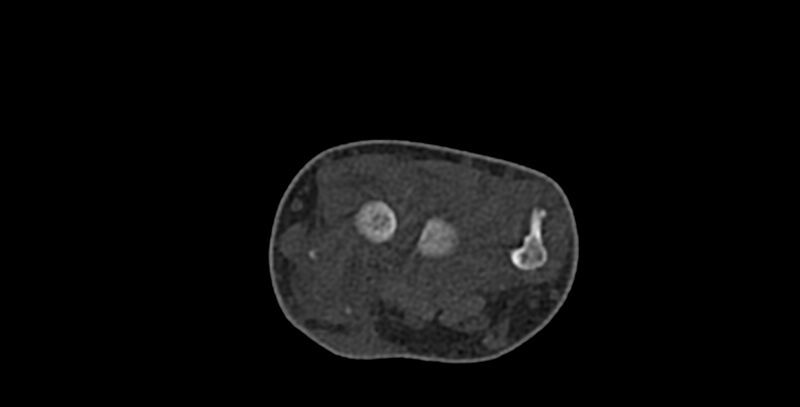 File:Calcifying aponeurotic fibroma (Radiopaedia 88423-105064 Axial bone window 44).jpg
