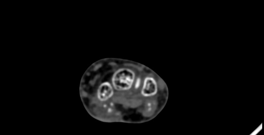 Calcifying aponeurotic fibroma (Radiopaedia 88423-105064 B 72).jpg