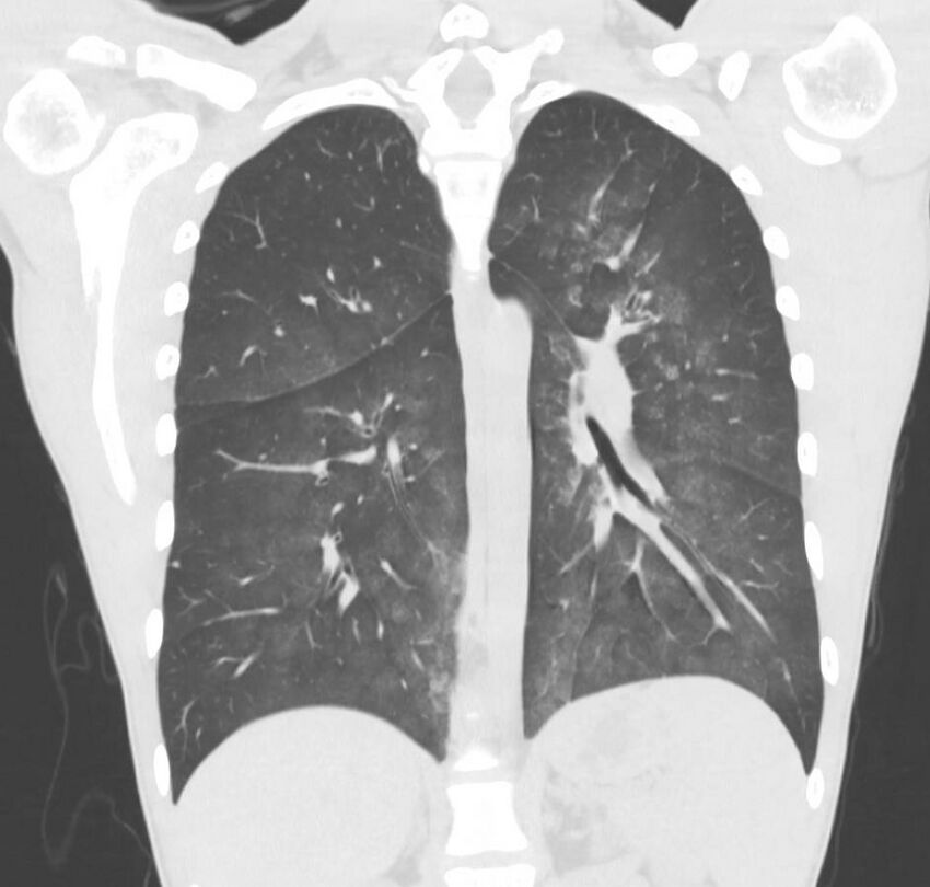 Cannabis-induced diffuse alveolar hemorrhage (Radiopaedia 89834-106946 Coronal lung window 34).jpg