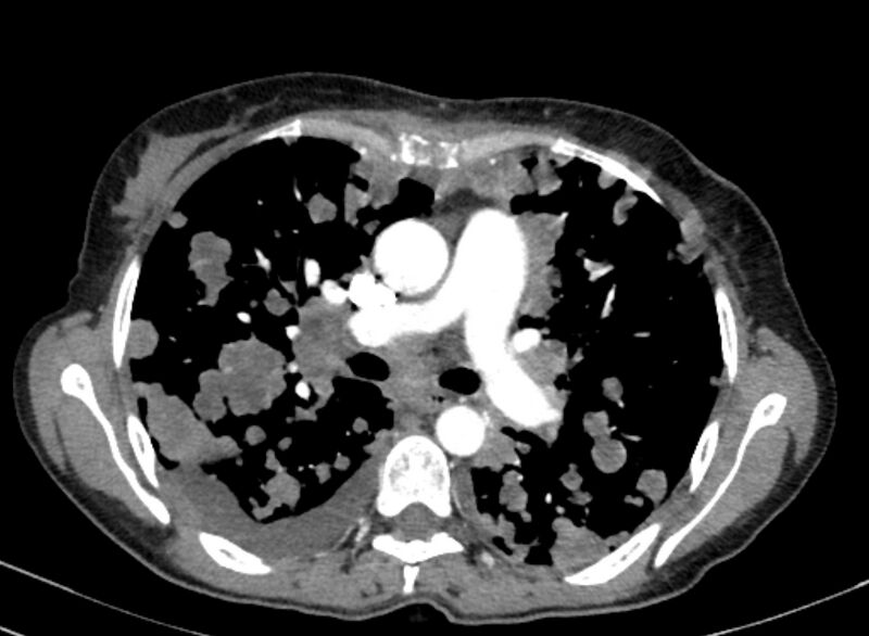 File:Cannonball metastases from breast cancer (Radiopaedia 91024-108569 A 53).jpg