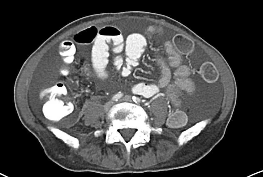 Carcinoid mesenteric tumor complicated by chylous ascites (Radiopaedia 76312-87953 A 47).jpg