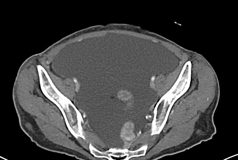 File:Carcinoid mesenteric tumor complicated by chylous ascites (Radiopaedia 76312-87953 A 63).jpg
