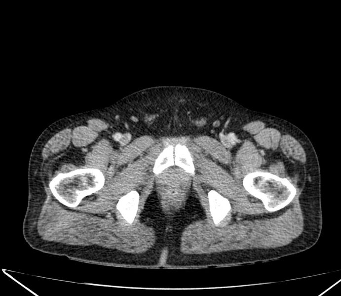 File:Carcinoid tumor with hepatic metastases (Radiopaedia 22651-22670 C 79).jpg