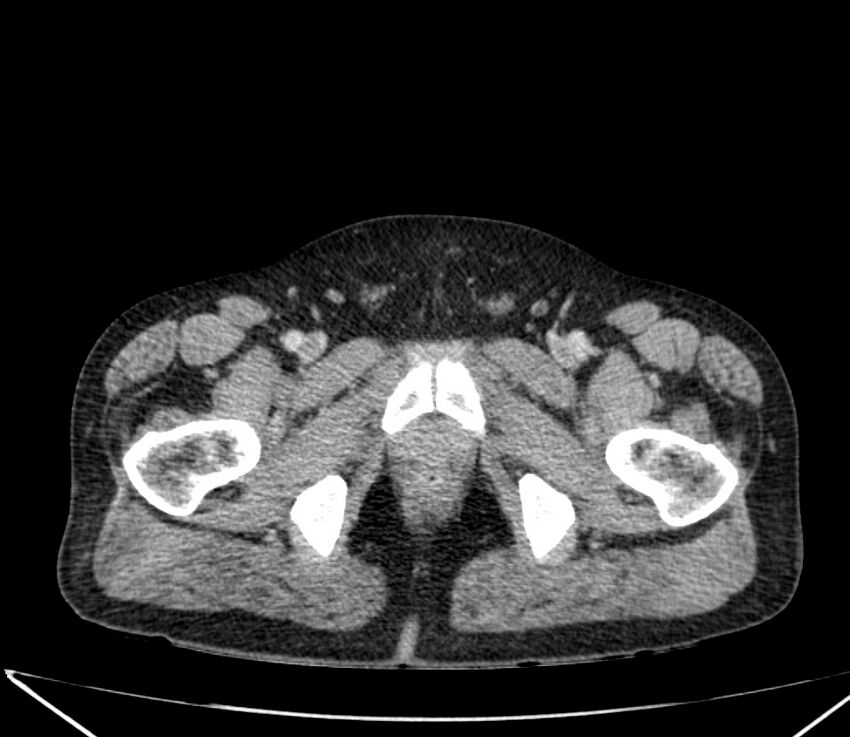 Carcinoid tumor with hepatic metastases (Radiopaedia 22651-22670 C 79).jpg