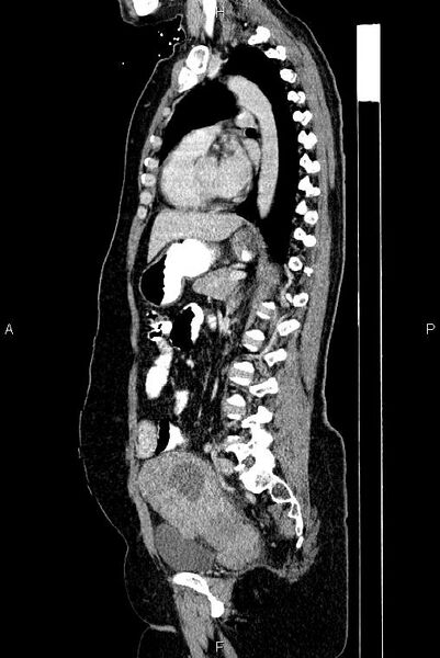 File:Carcinoma of uterine cervix (Radiopaedia 85861-101700 D 50).jpg