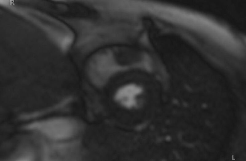 File:Cardiac hemangioma (Radiopaedia 31709-32631 Short axis 95).jpg