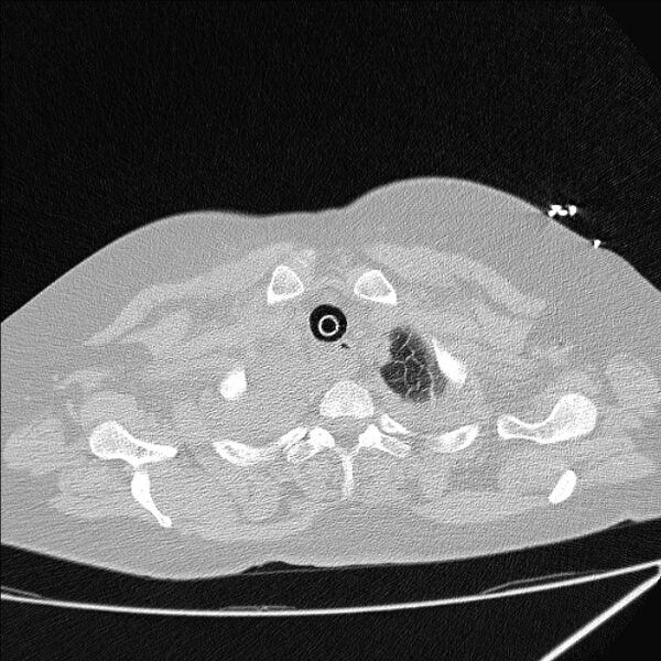 File:Cardiogenic pulmonary edema (Radiopaedia 29213-29609 Axial lung window 5).jpg