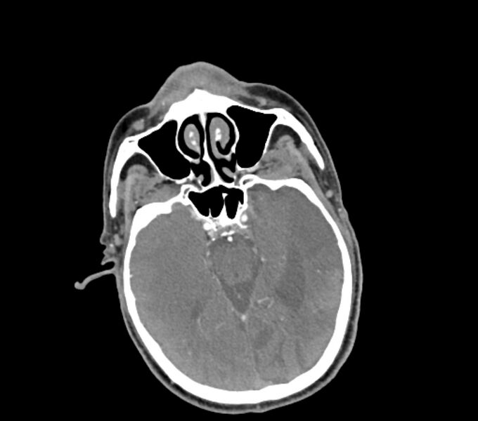 File:Carotid artery pseudoaneurysm (Radiopaedia 84030-99259 C 2).jpg