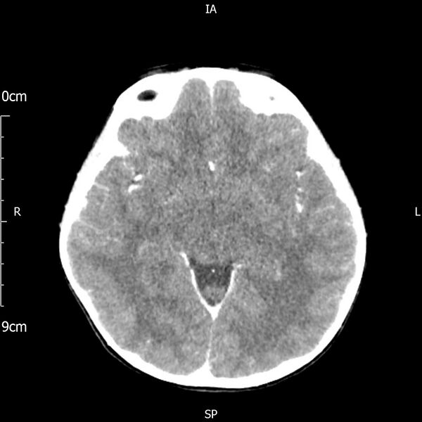 File:Cavernous sinus thrombosis (Radiopaedia 79414-92510 Axial Brain 98).jpg