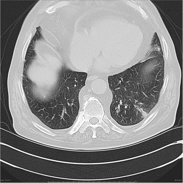 File:Cavitating left lower lobe lesion - squamous cell lung cancer (Radiopaedia 27749-28176 Axial lung window 39).jpg
