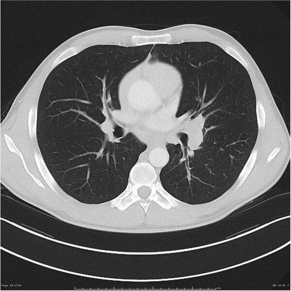 File:Cavitating lung cancer (Radiopaedia 25796-25945 Axial lung window 28).jpg