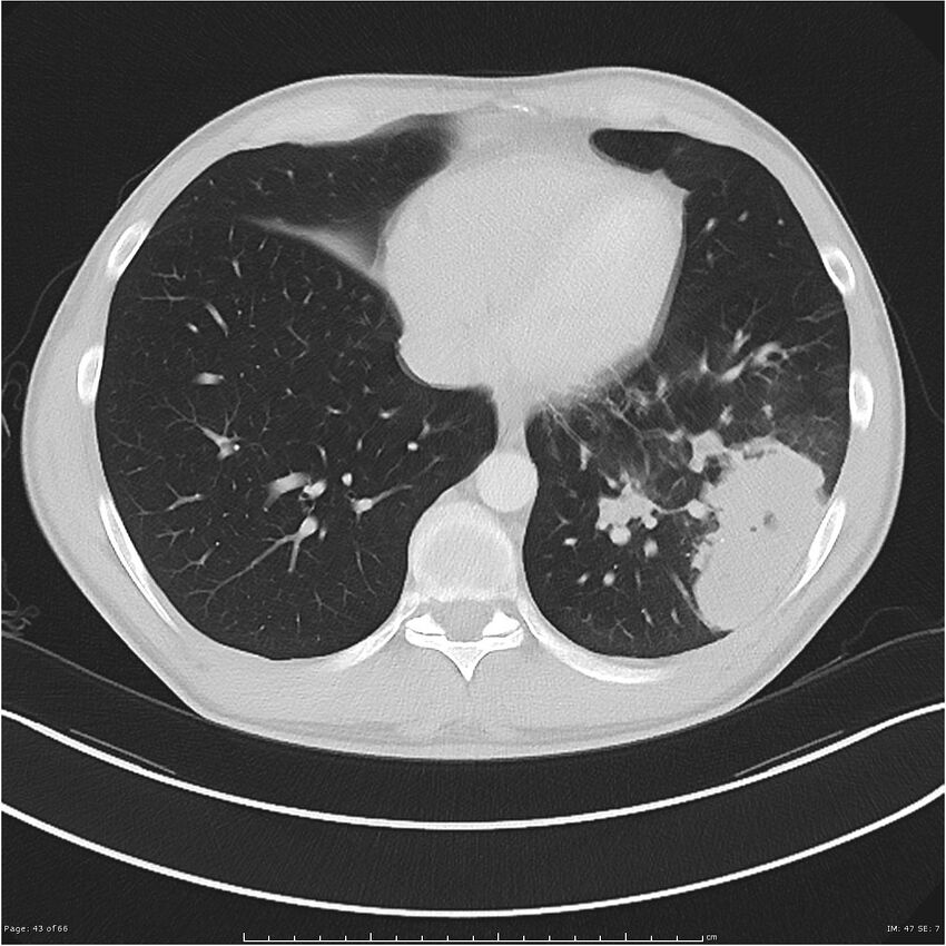 Cavitating lung cancer (Radiopaedia 25796-25945 Axial lung window 43).jpg