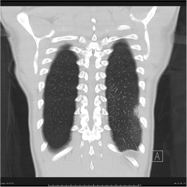 File:Cavitating lung cancer (Radiopaedia 25796-25945 lung window 39).jpg