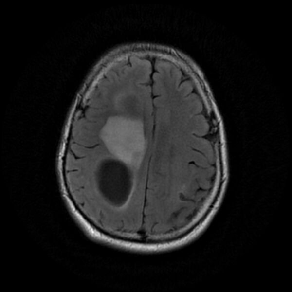 File:Central neurocytoma (Radiopaedia 67618-77021 Axial FLAIR 19).jpg