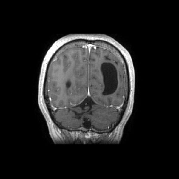 File:Central neurocytoma (Radiopaedia 67618-77021 Coronal T1 C+ 4).jpg