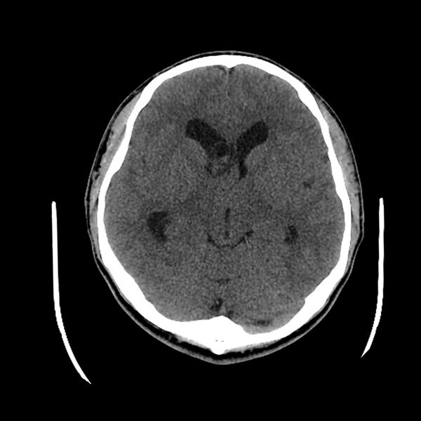 File:Central neurocytoma (Radiopaedia 79320-92379 Axial non-contrast 23).jpg