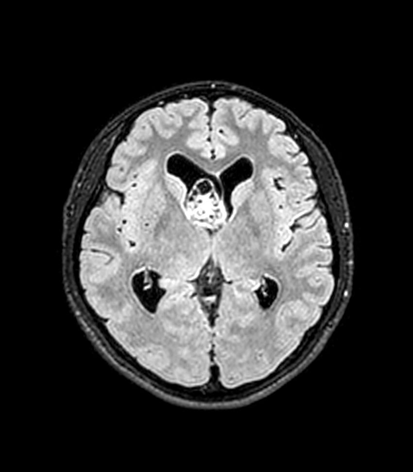 Central neurocytoma (Radiopaedia 79320-92380 Axial FLAIR 163).jpg