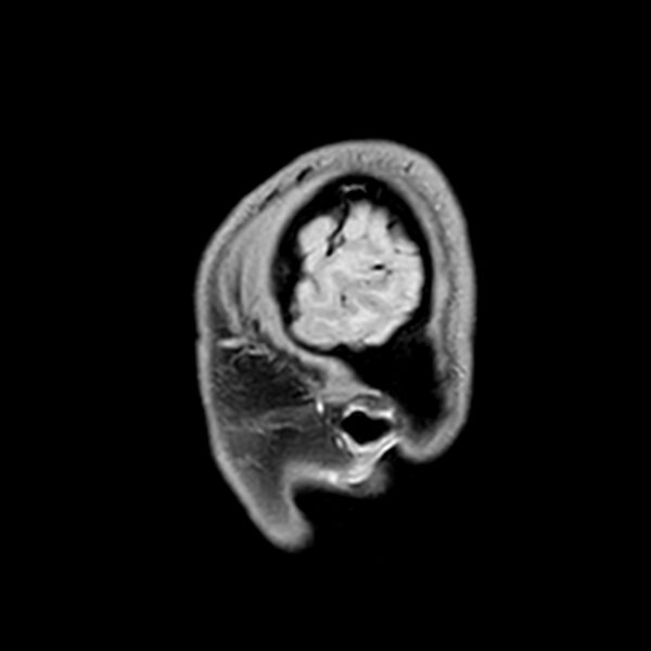 File:Central neurocytoma (Radiopaedia 79320-92380 Sagittal T1 242).jpg