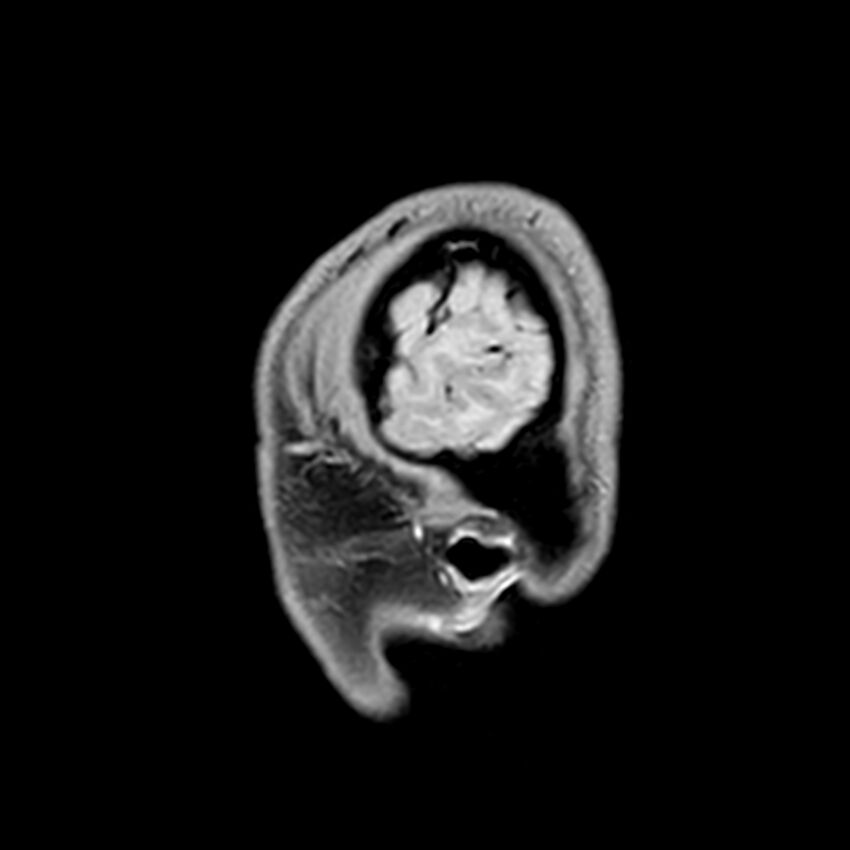 Central neurocytoma (Radiopaedia 79320-92380 Sagittal T1 242).jpg
