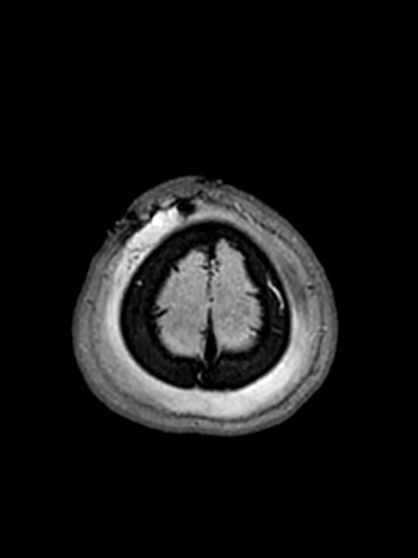 Central neurocytoma (Radiopaedia 79320-92381 Axial FLAIR 27).jpg