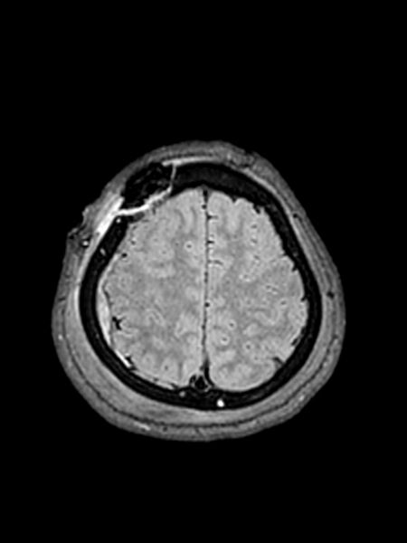 File:Central neurocytoma (Radiopaedia 79320-92381 Axial FLAIR 41).jpg