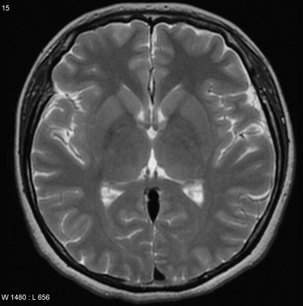 File:Cerebellar arteriovenous malformation (Radiopaedia 5220-6988 Axial T2 11).jpg