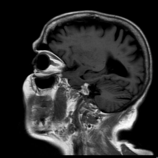 File:Cerebellar ataxia with neuropathy and vestibular areflexia syndrome (CANVAS) (Radiopaedia 74283-85159 Sagittal FLAIR 15).jpg