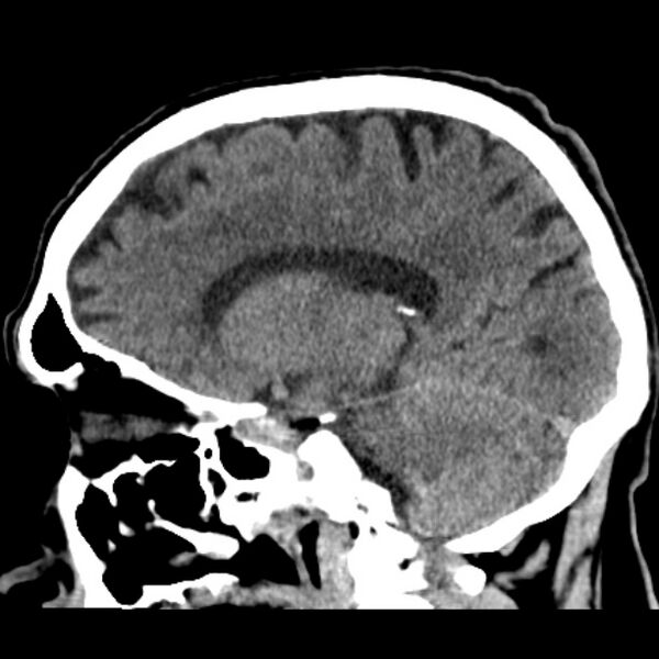 File:Cerebellar hemorrhage (Radiopaedia 27193-27359 C 18).jpg