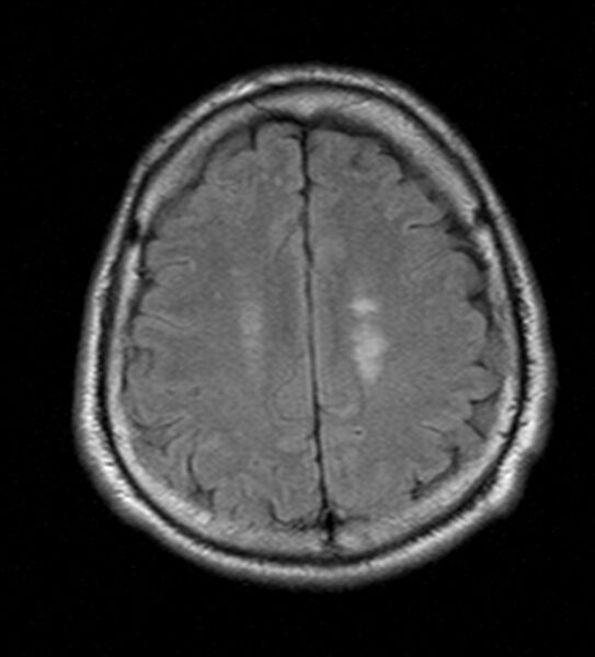 File:Cerebellopontine angle meningioma (Radiopaedia 24459-24764 Axial FLAIR 19).jpg