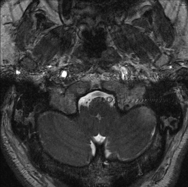 File:Cerebellopontine angle meningioma (Radiopaedia 24459-24764 I 4).jpg