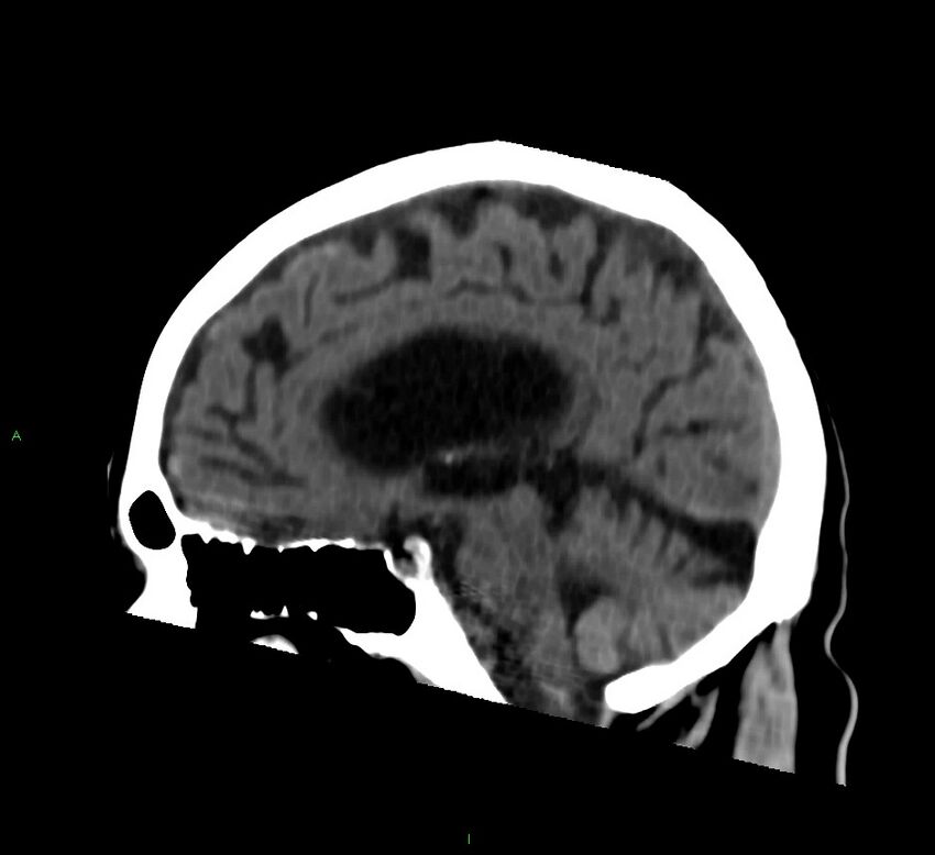 Cerebral amyloid angiopathy-associated lobar intracerebral hemorrhage (Radiopaedia 58376-65513 C 40).jpg
