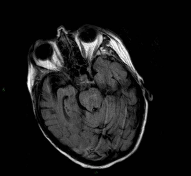 File:Cerebral amyloid angiopathy-associated lobar intracerebral hemorrhage (Radiopaedia 58377-65515 Axial FLAIR 18).jpg