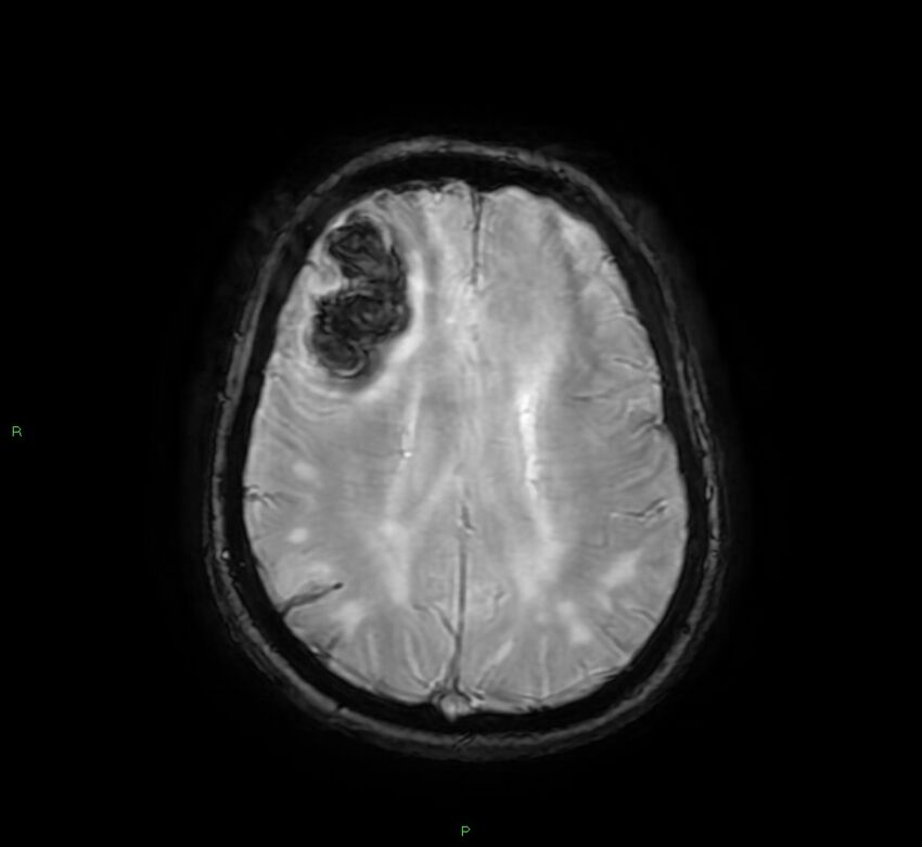 Cerebral amyloid angiopathy-associated lobar intracerebral hemorrhage (Radiopaedia 58378-65517 Axial SWI 49).jpg