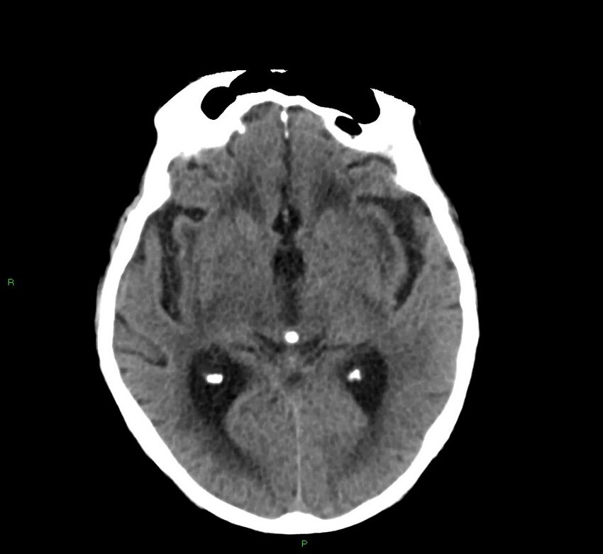 Cerebral amyloid angiopathy-associated lobar intracerebral hemorrhage (Radiopaedia 58530-65688 Axial non-contrast 28).jpg