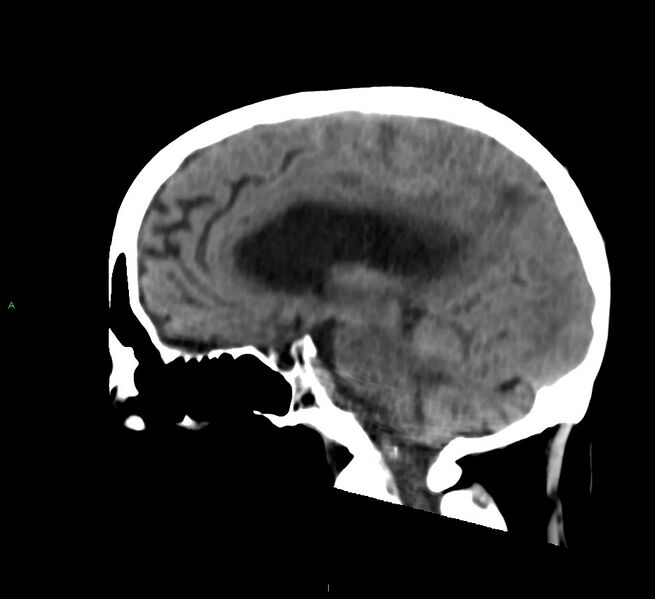 File:Cerebral amyloid angiopathy-associated lobar intracerebral hemorrhage (Radiopaedia 58530-65688 C 25).jpg