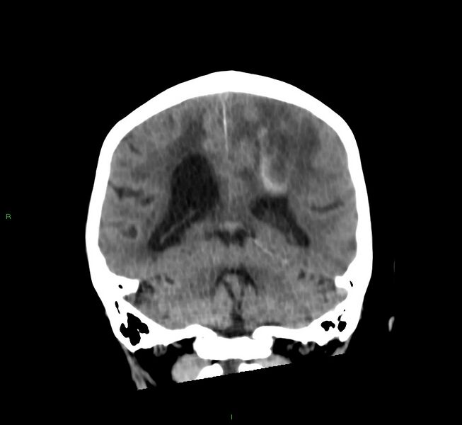 File:Cerebral amyloid angiopathy-associated lobar intracerebral hemorrhage (Radiopaedia 58530-65688 Coronal non-contrast 26).jpg