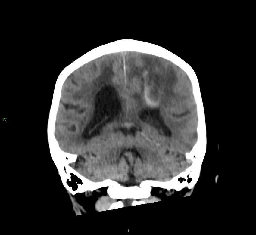 Cerebral amyloid angiopathy-associated lobar intracerebral hemorrhage (Radiopaedia 58530-65688 Coronal non-contrast 26).jpg
