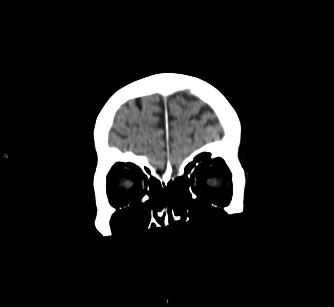 File:Cerebral amyloid angiopathy-associated lobar intracerebral hemorrhage (Radiopaedia 58530-65688 Coronal non-contrast 56).jpg