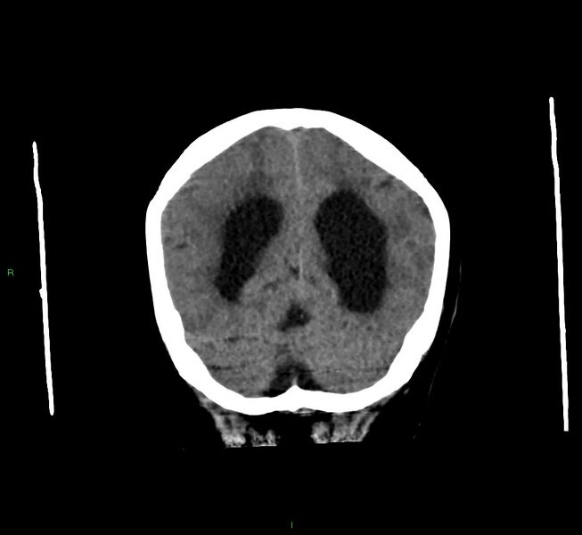File:Cerebral amyloid angiopathy-associated lobar intracerebral hemorrhage (Radiopaedia 58560-65723 Coronal non-contrast 19).jpg
